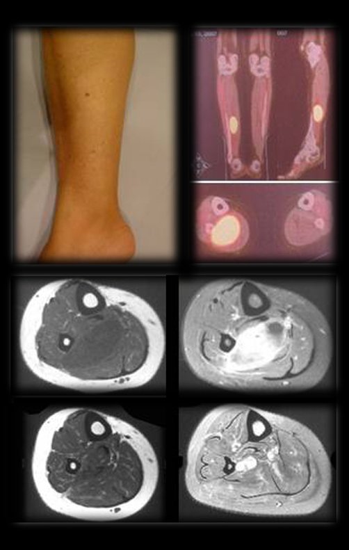 Figura 49: Perna com aumento de volume na panturrilha; pet-cet com alta captação na lesão; Rm em T1 e T1 com contraste pré e pós quimioterapia, em 2008