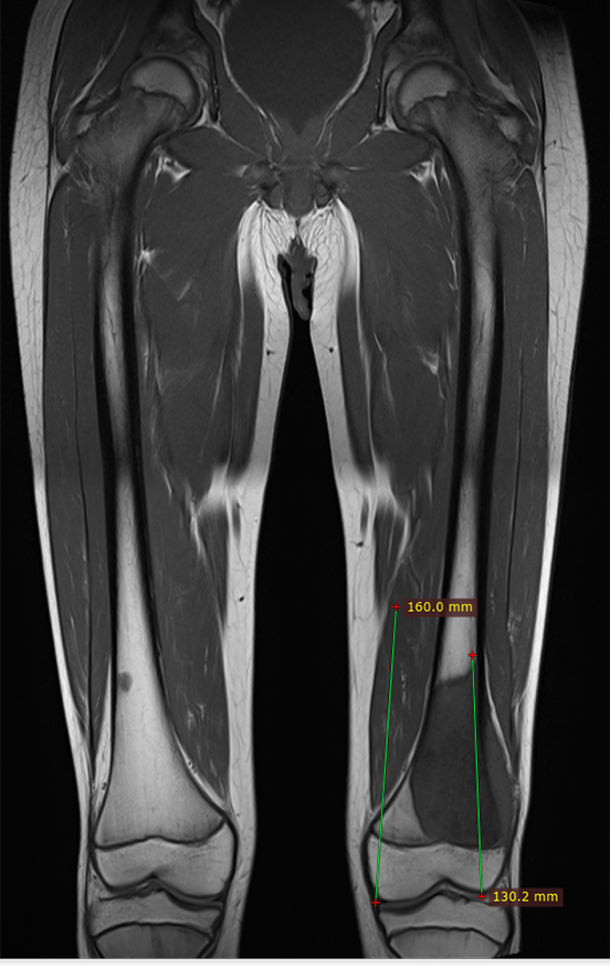 Figura 26: Rm coronal T1 pós quimioterapia, avaliando a extensão da lesão.