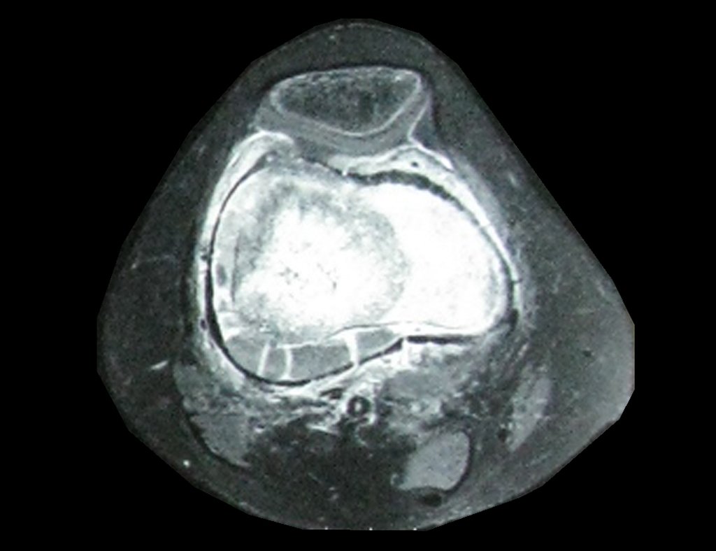 Figura 13: RM axial fat T1, lesão metafisária e tumor extracortical.