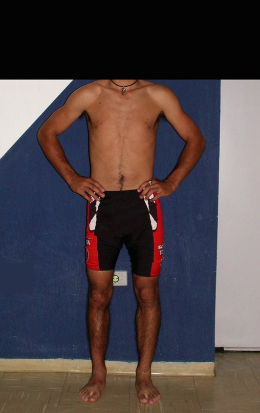Figura 129: Após três anos e oito meses, função normal do membro operado, em 03/06/2003.
