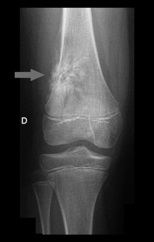 Figura 1: Radiografia do 1/3 distal do fêmur direito, com lesão de condensação óssea de limites imprecisos e triângulo de Codman com reação periosteal em raios de sol.