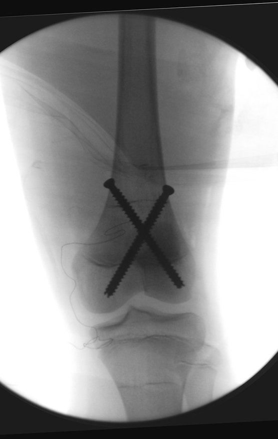 Figura 182: Controle do posicionamento, frente. Parafusos justa cortical, para não incomodar o paciente, sem atingir a cartilagem articular.