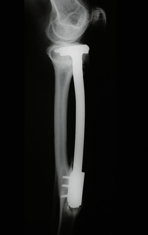Figura 134: Radiografia perfil, com excelente hipertrofia da fíbula, em 03/06/2003, após três anos e oito meses.
