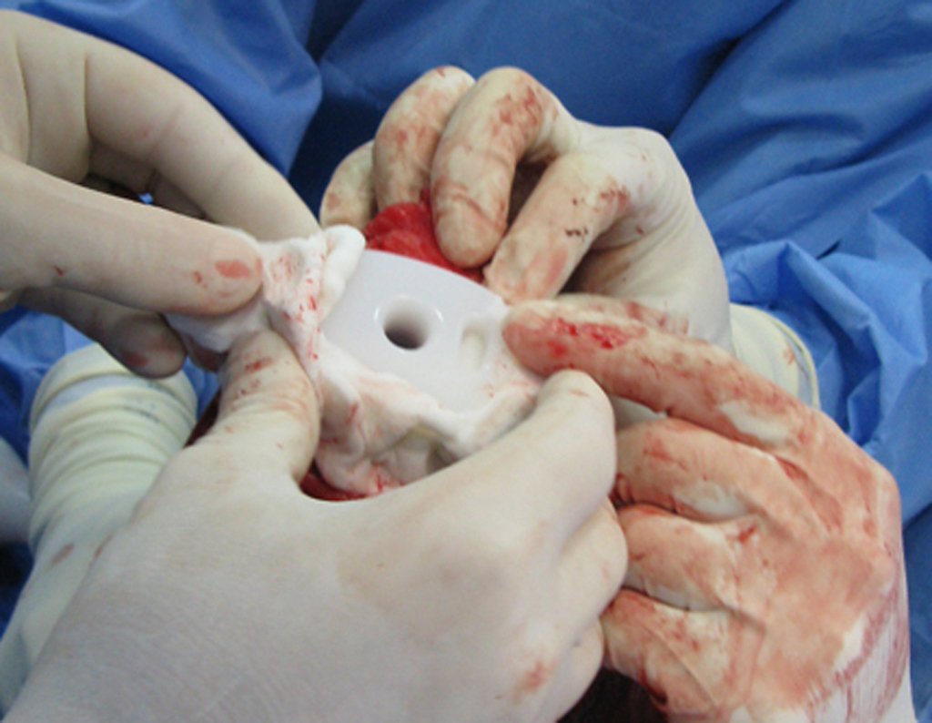 Figura 73: Cimentação circunferencial do platô da tíbia e do componente tibial da prótese.