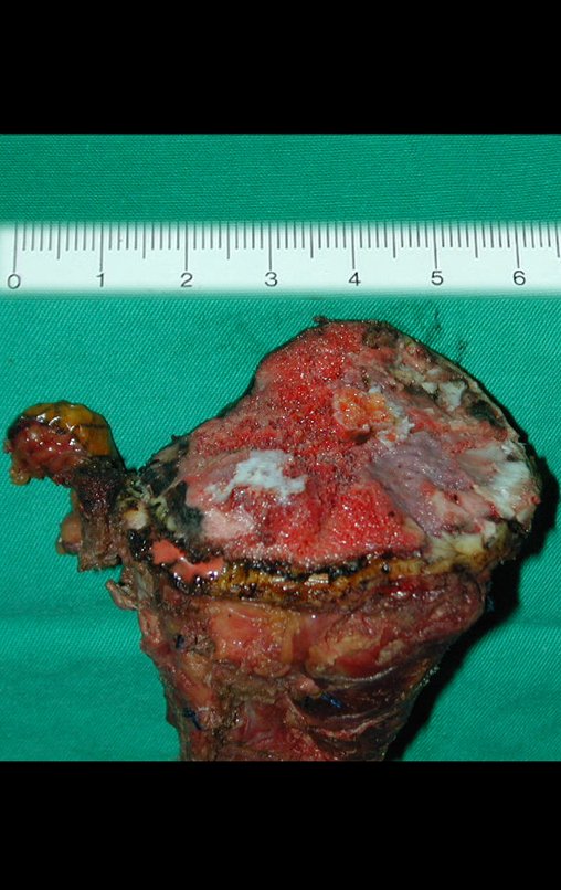 Figura 51: Detalhe do corte superior da tíbia, intraepifisário e curvilíneo, removendo toda a cartilagem de crescimento.