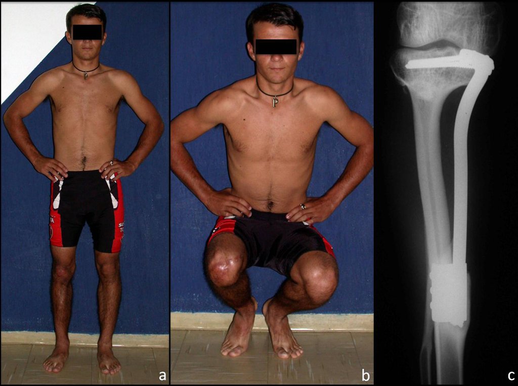 Figure 9: a) paciente com 3 anos e 7 meses de pós-operatório, com carga total, b) com 3 anos e 7 meses, flexão com carga e boa função dos joelhos, e c) radiografia com 3 anos e 7 meses, fibula hipertrofiada, já totalmente tibializada