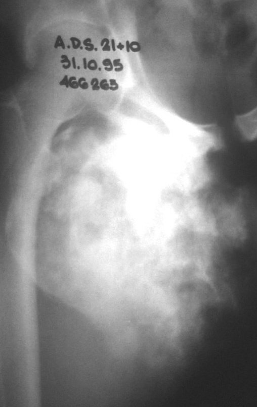 Figura 4: Grande condrossarcoma implantado no ramo íliopúbico