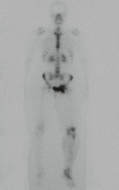 Figura 66: Na osteocondromatose a incidência de degeneração é dez vezes maior e é mais frequênte quando a lesão é na raíz do membro. O mapeamento mostra captação do lado esquerdo, no ilíaco e na perna.