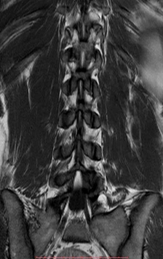 Figura 2: Ressonância, coronal T1 da coluna lombar, sem alteração.
